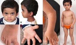 Câu hỏi thường gặp liên quan đến loạn sản sụn xương
