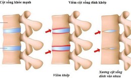 Vi&#234;m cột sống d&#237;nh khớp: Nguy&#234;n nh&#226;n, triệu chứng, ph&#242;ng ngừa v&#224; điều trị