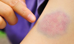 Thuốc điều trị xuất huyết giảm tiểu cầu