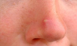 Cách phòng bệnh ngoài da thường gặp ngày hè