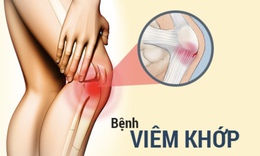 Viêm khớp: Nguyên nhân, triệu chứng, cách điều trị và phòng ngừa