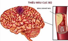 Cách phòng ngừa cục máu đông