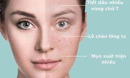 Cách làm đẹp cho da dầu, có mụn ẩn