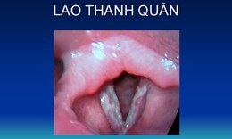 Lao thanh quản: Nguyên nhân, biểu hiện, cách điều trị và phòng bệnh