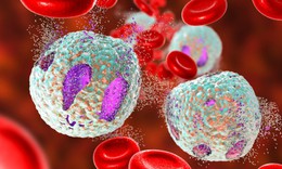 Leukemia kinh dòng bạch cầu hạt: Nguyên nhân, biểu hiện, cách điều trị và phòng bệnh