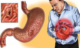 Loét dạ dày tá tràng: Nguyên nhân, biểu hiện, cách điều trị và phòng bệnh