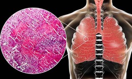 Lao kê: Nguyên nhân, biểu hiện, cách điều trị và phòng bệnh