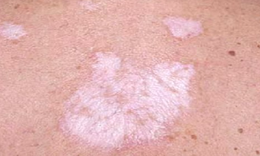 Lichen xơ hóa: Nguyên nhân, biểu hiện, cách điều trị và phòng bệnh