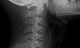 Cảnh b&#225;o cột sống cổ ‘thẳng như c&#226;y gậy’ ở người trẻ tuổi do sai tư thế k&#233;o d&#224;i