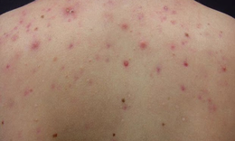 Nóng gan gây nổi mụn lưng?
