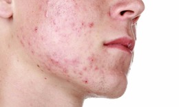 Cách trị mụn trứng cá hiệu quả nhất