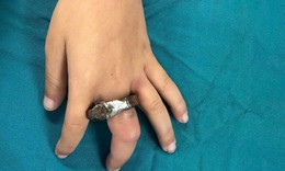 Vòng khóa siết ngón tay bé trai, gia đình cưa cửa mang đến viện
