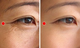 5 động tác đơn giản hằng ngày xóa mờ nếp nhăn đuôi mắt
