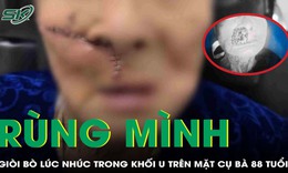 Rùng mình: Giòi bò lúc nhúc trong khối u trên mặt cụ bà 88 tuổi ở Quảng Nam