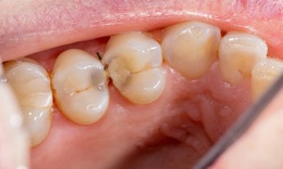 Những dấu hiệu cảnh báo cơ thể thiếu canxi người Việt dễ bỏ qua