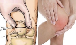 Viêm tủy xương: Nguyên nhân, triệu chứng, cách điều trị và phòng ngừa