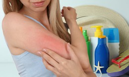 Cách xử trí khi bị dị ứng kem chống nắng