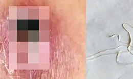 Bệnh giun rồng tái xuất do ăn gỏi cá, ếch, rắn chưa nấu chín nguy hiểm như thế nào?