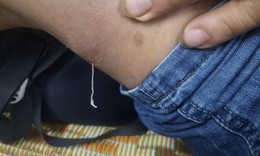 Ăn gỏi cá, uống nước lã dễ nhiễm giun rồng dài hàng mét, cực nguy hiểm