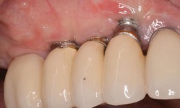 Implant bị đào thải do đâu? Cách khắc phục?