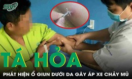 Kinh hãi hình ảnh giun rồng chui lên qua da, phát hiện nhiều ổ giun áp xe khắp cơ thể
