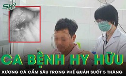 Ca bệnh hy hữu: Mảnh xương sắc nhọn cắm sâu trong phế quản suốt 5 tháng