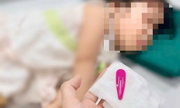 Thót tim gắp chiếc kẹp tóc sắc nhọn dài 5 cm trong dạ dày bé gái