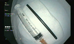 Bệnh nhi đau bụng ba ng&#224;y, v&#224;o viện mới biết c&#243; dị vật đường ti&#234;u h&#243;a