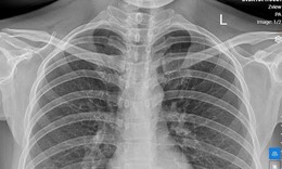 Thoát vị Bochdalek ở người lớn