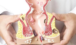 C&#225;ch để hạn chế bệnh trĩ ph&#225;t triển 