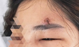 Nặn mụn bằng tay, người phụ nữ gặp nguy vì nhiễm trùng nặng