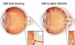 Glocom bẩm sinh ở trẻ em c&#243; chữa được kh&#244;ng?