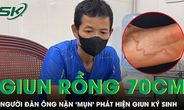 Tự nặn mụn, người đàn ông phát hiện giun rồng dài 70cm ký sinh trong cơ thể