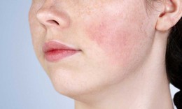 7 tác dụng phụ thường gặp khi sử dụng retinol và cách phòng ngừa