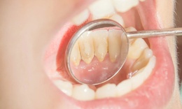 Cách nhận biết cao răng đang tích tụ