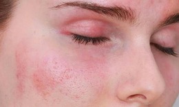 Sử dụng kem chống nắng giả nguy hiểm như thế nào?