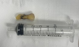 Gắp chiếc răng của cụ &#244;ng bị đột quỵ n&#227;o rơi v&#224;o đường thở