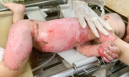 B&#233; 2 tuổi bỏng 60% được cứu sống nhờ gh&#233;p da từ mẹ