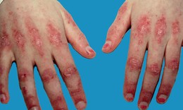 Chăm s&#243;c, theo d&#245;i bệnh vi&#234;m da cơ, vi&#234;m đa cơ cần lưu &#253; g&#236;?