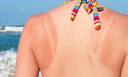 Cách phục hồi làn da sau rám nắng mùa hè