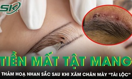 Xăm ch&#226;n m&#224;y t&#224;i lộc, c&#244; g&#225;i l&#226;m v&#224;o thảm họa nhan sắc phải cầu cứu b&#225;c sĩ