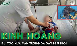 Lấy b&#250;i t&#243;c nặng nửa c&#226;n trong dạ d&#224;y b&#233; trai 5 tuổi