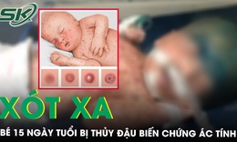 X&#243;t xa b&#233; sơ sinh 15 ng&#224;y tuổi bị thủy đậu biến chứng &#225;c t&#237;nh