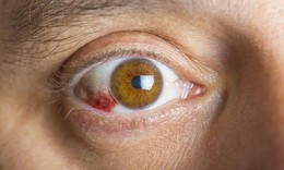 Viêm củng mạc có nguy hiểm không?