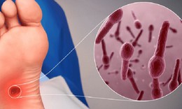 Chủ quan với vết thương nhỏ c&#243; thể mắc uốn v&#225;n nguy hiểm