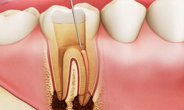 Điều trị lấy tuỷ buồng cho răng viêm tuỷ có tổn thương quanh chóp: Cơ hội giữ lại tuỷ sống cho răng