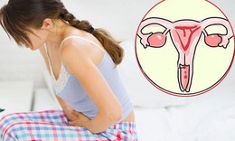 5 dấu hiệu nghi ngờ ung thư cổ tử cung chị em cần biết