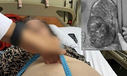 Cụ b&#224; 75 tuổi c&#243; khối u chiếm gần to&#224;n bộ ổ bụng