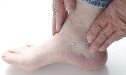 Biểu hiện biến chứng thận ở bệnh nhân tiểu đường