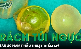 Rách túi ngực sau 20 năm phẫu thuật thẩm mỹ